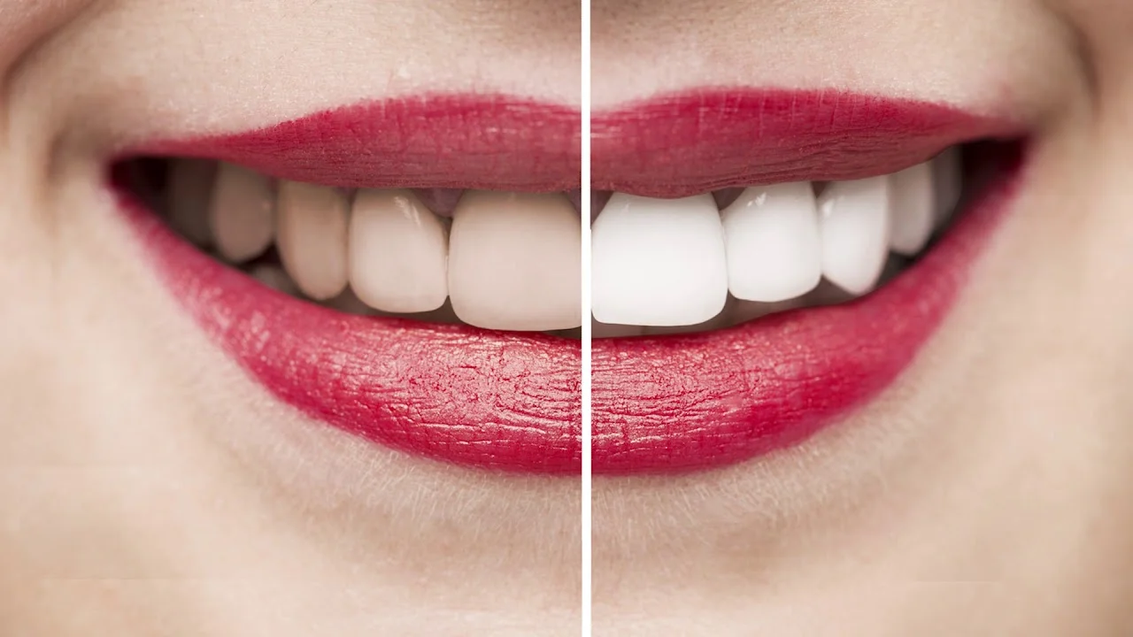 Before and after comparison of teeth whitening