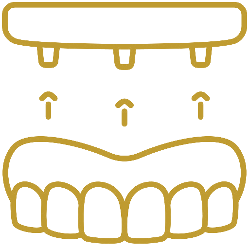 All-on-X Full-Arch Implants