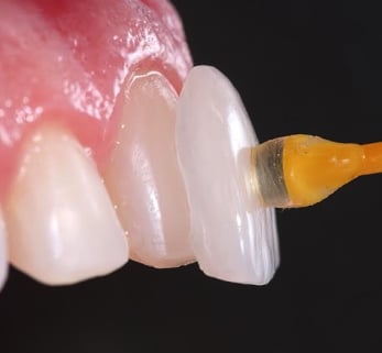 Cosmetic Dentistry in Deira Dubai
