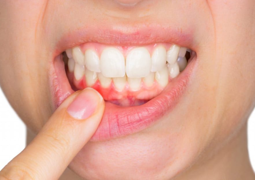 Gum Disease Treatment in Deira Dubai