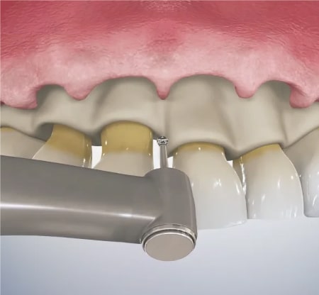Aesthetic Gum Surgery in Al Rigga