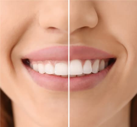Aesthetic Gum Surgery in Deira