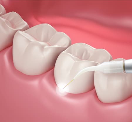 Aesthetic Gum Surgery in Deira