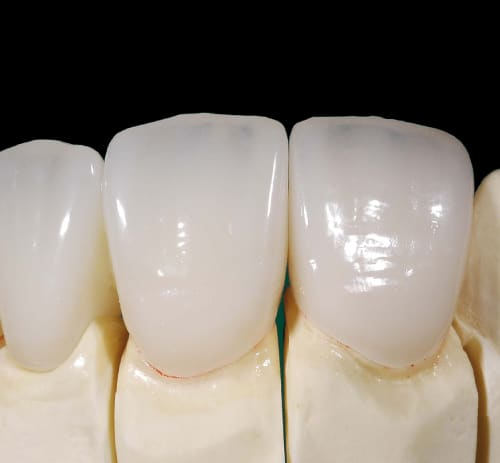 CROWNS AND BRIDGES SERVICES IN DUBAI