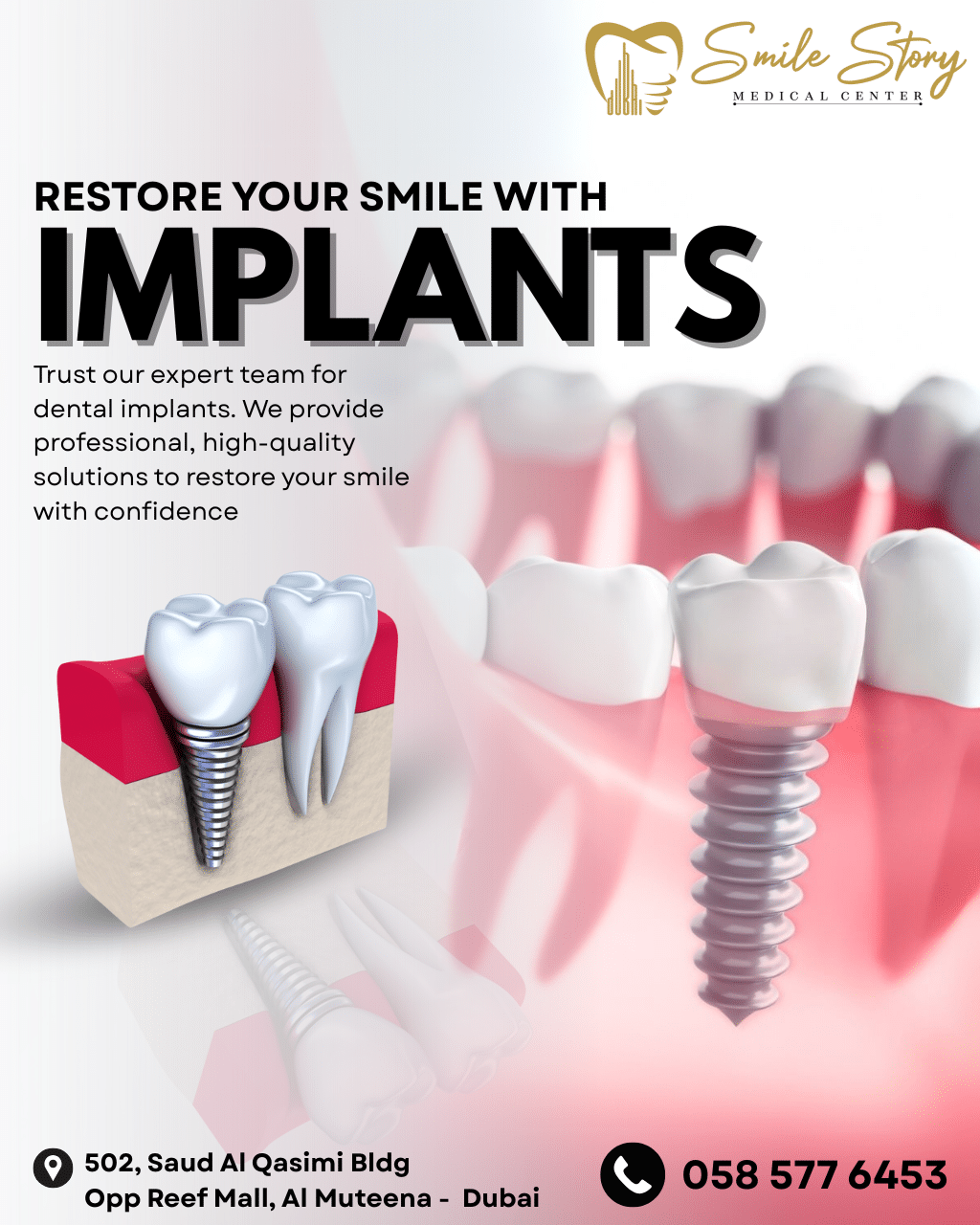 Dental implants in Al Rigga