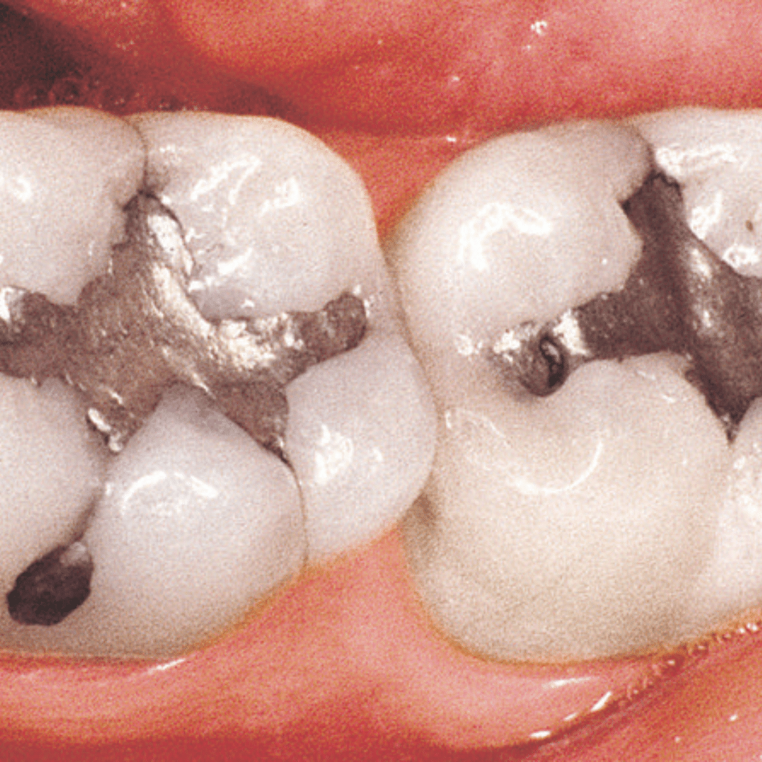 Re-treatment in Dubai