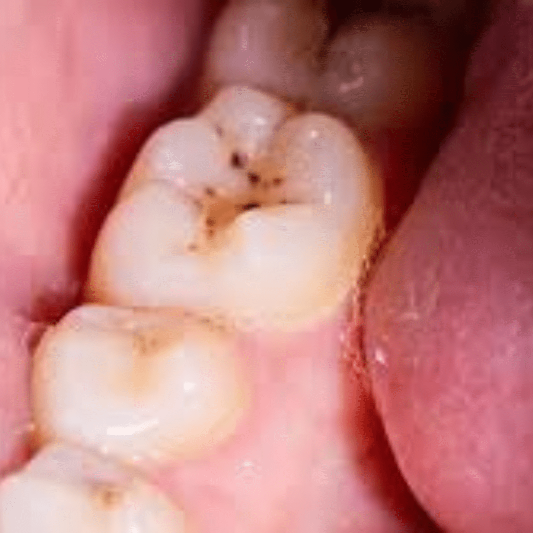 Re-treatment in Dubai