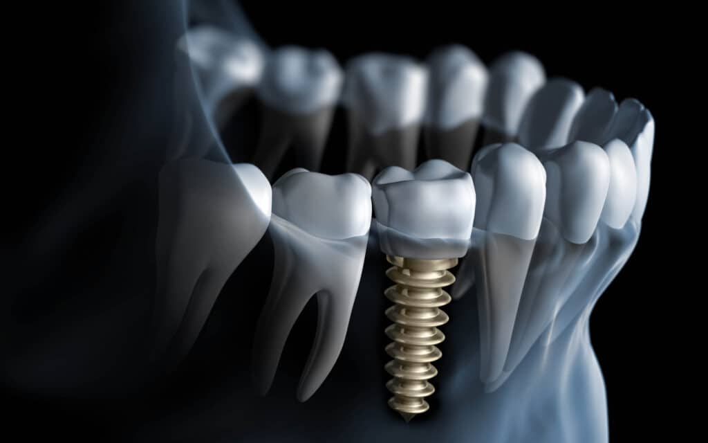 Dental Implant In Al Rigga Dubai