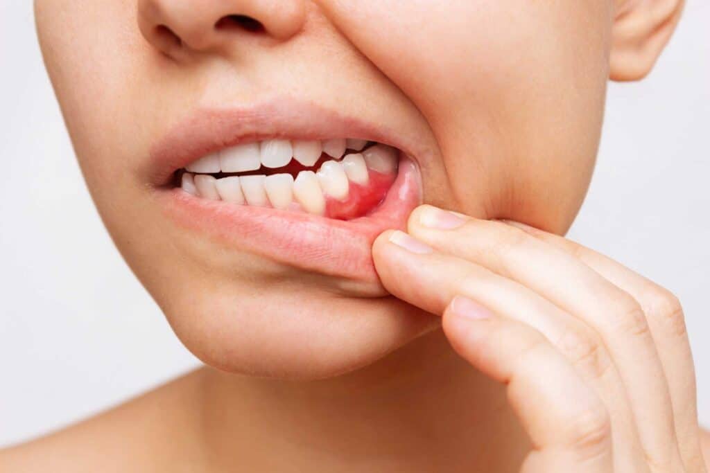Gum Disease Treatment in Dubai