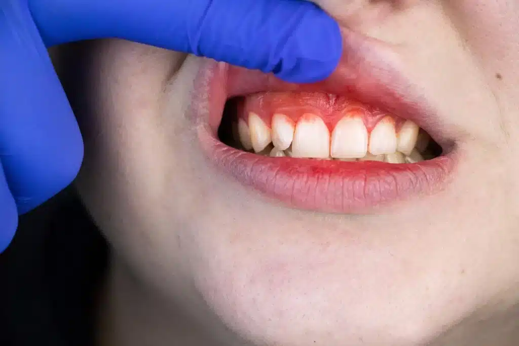 Gum Disease Treatment in Dubai